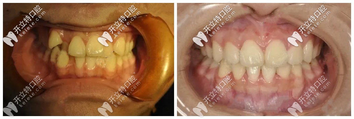 矫牙前后对比
