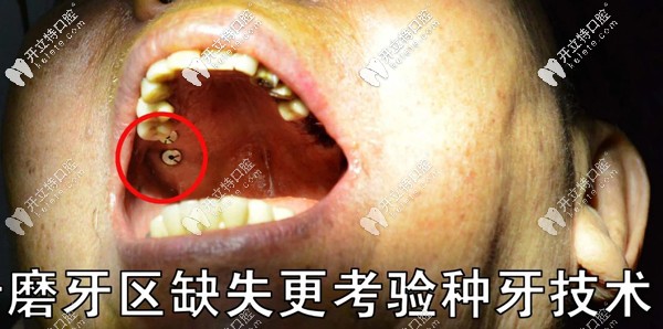 磨牙区缺失更考验种植牙技术