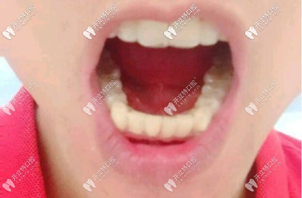 牙齿矫正后照片
