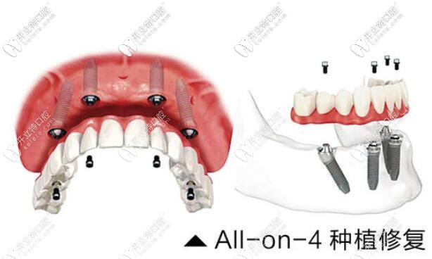 ALL-ON-4种植牙技术