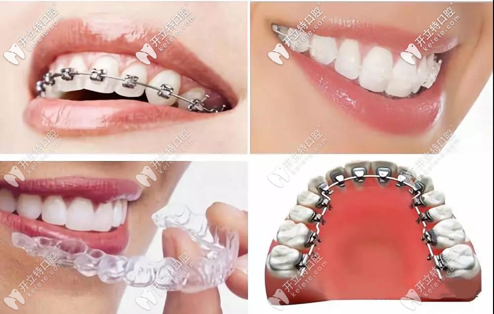 牙齿正畸4种类型选择矫正的价格收费