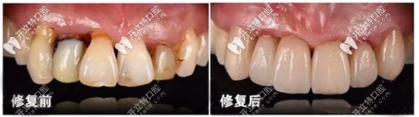 氧化锆全瓷牙修复案例