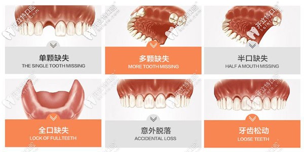 出现图中六种情况需要种植牙