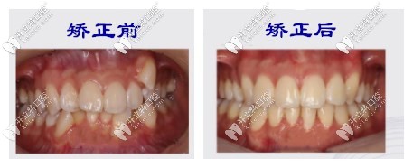 矫正前后对比 矫正前后对比