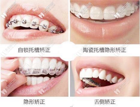 牙套的几种 牙套的几种