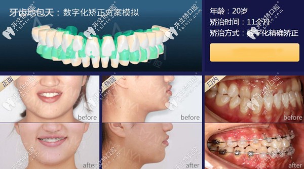 厦门麦芽口腔地包天牙齿矫正案例 厦门麦芽口腔地包天牙齿矫正案例