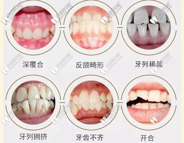 牙齿畸形主要有哪些