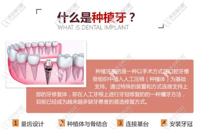 什么是种植牙