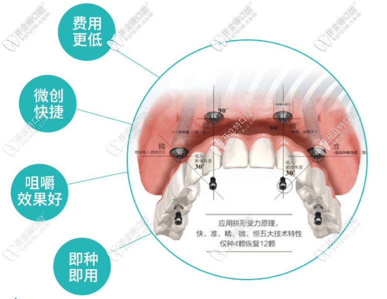 当天种牙当天用靠谱