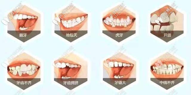 牙齿需要矫正的类型