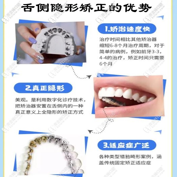 舌侧隐形矫正的优势 舌侧隐形矫正的优势