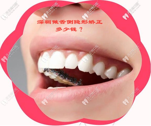 在深圳做舌侧隐形矫正的收费价格是多少钱