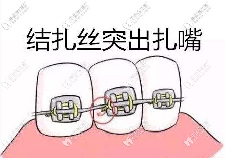 传统金属牙套