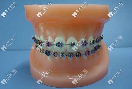 直丝弓矫正器外观 直丝弓矫正器外观