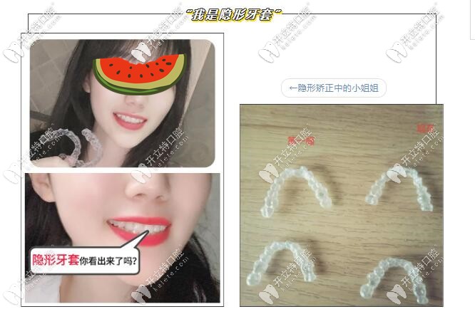 隐形牙套图示 隐形牙套图示
