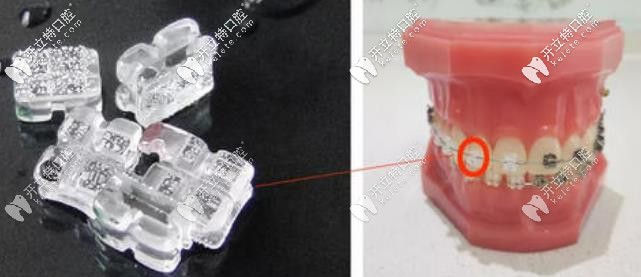 冰晶托槽矫正 冰晶托槽矫正