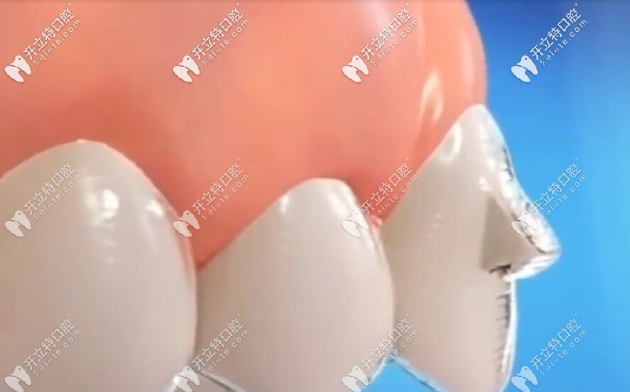 透明牙套 透明牙套