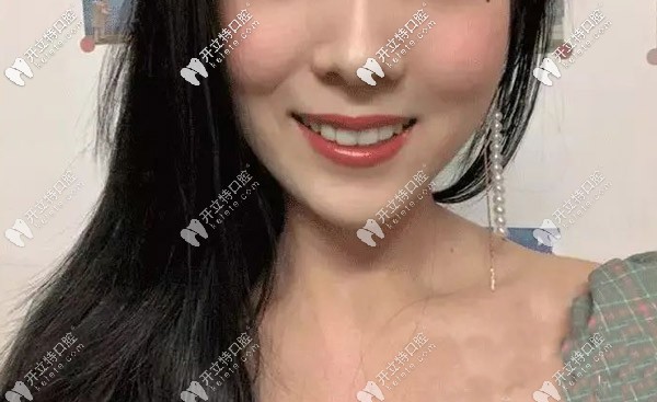 龅牙隐形矫正效果 龅牙隐形矫正效果