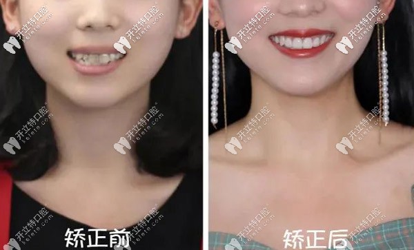 龅牙矫正 龅牙矫正