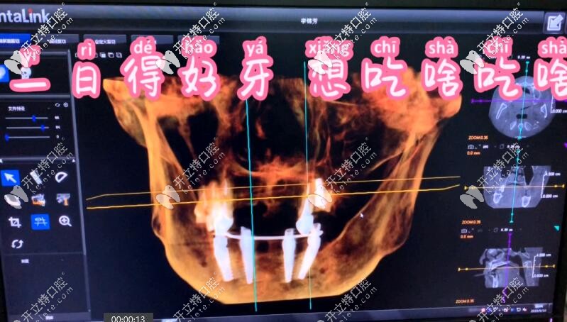 国医康顾客做了allon4下半口即刻负重种植牙后拍的CT