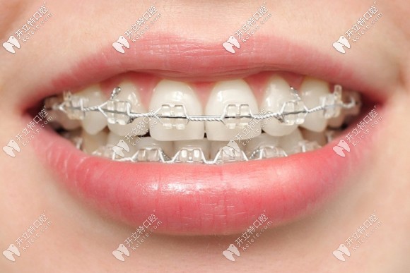 康贝齿科的牙齿矫正价格