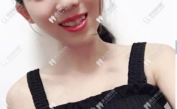 正雅日夜版隐形矫正 正雅日夜版隐形矫正