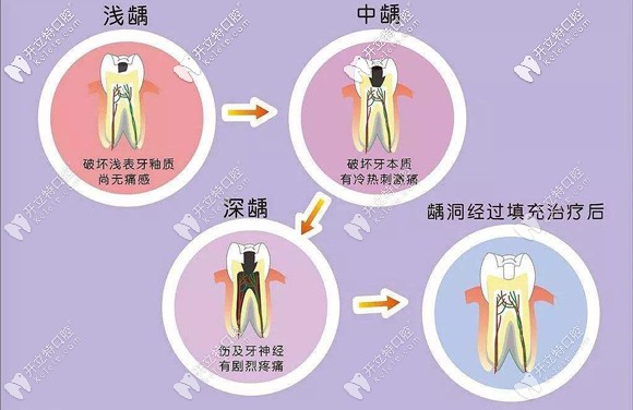 不同补牙技术也决定了补牙的收费 不同补牙技术也决定了补牙的收费