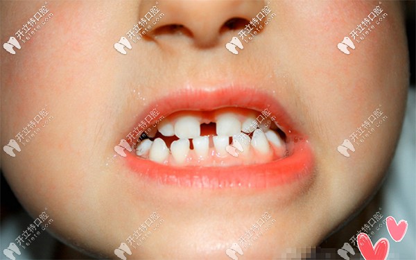 婴儿门牙缝隙大图片图片