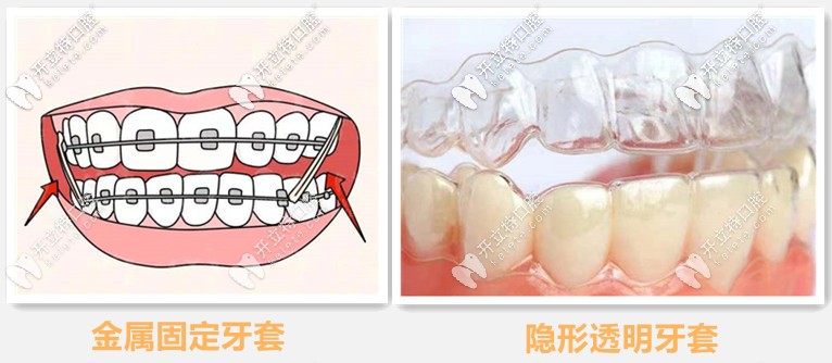 金属牙套与隐形牙套