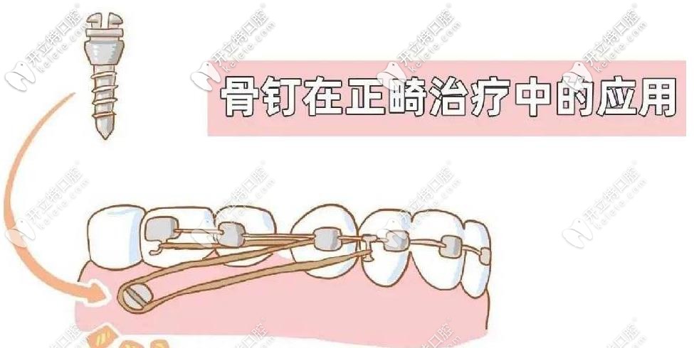 打骨钉的痛感 打骨钉的痛感
