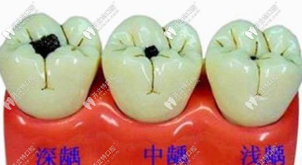 龋齿程度决定了补牙价格 龋齿程度决定了补牙价格