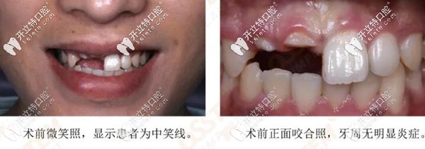 前牙美学区做韩国奥齿泰TSIII SA即刻种植牙的真人案例