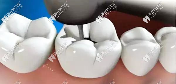 补牙过程中的窝洞制备