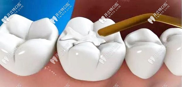 补牙过程的充填修复