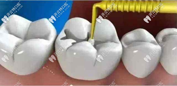 补牙过程中的窝洞消毒