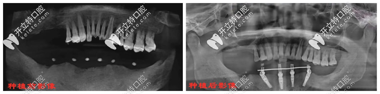 种植牙前后影像对比