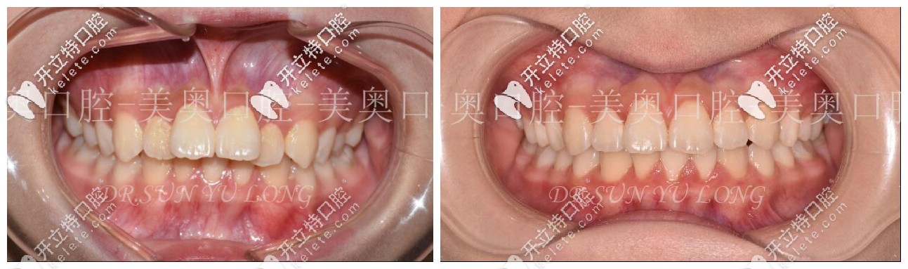 龅牙矫正前后对比图 龅牙矫正前后对比图