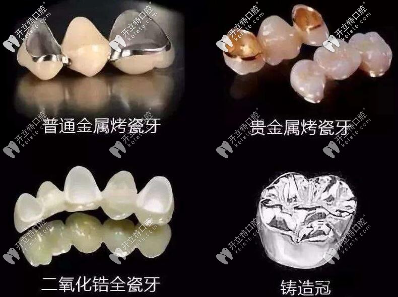 假牙的类型