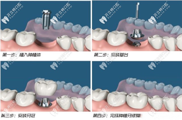 种植牙的流程