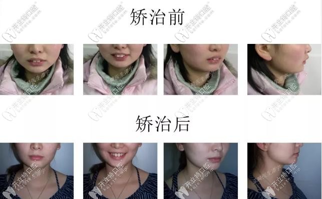 兔牙小妹妹--牙齿矫正对比图