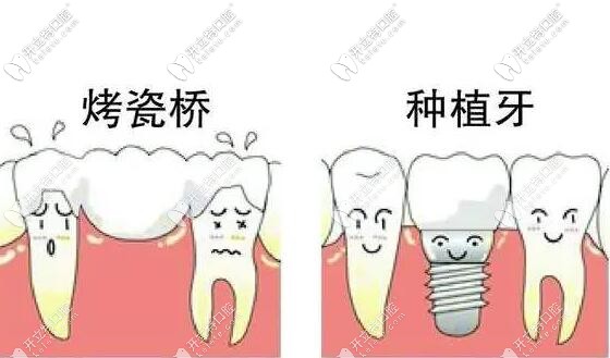 种植修复和固定牙冠相比,医生为什么选择前者
