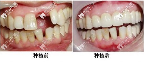 种植牙前后对比 种植牙前后对比