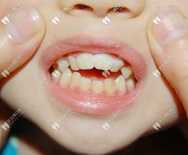 小孩龅牙什么时候矫正好？