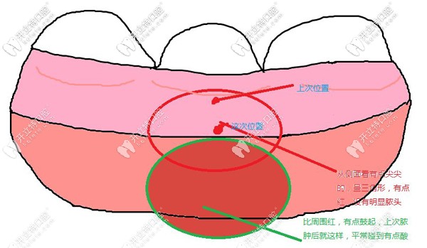 牙周脓肿也会引起牙齿疼痛