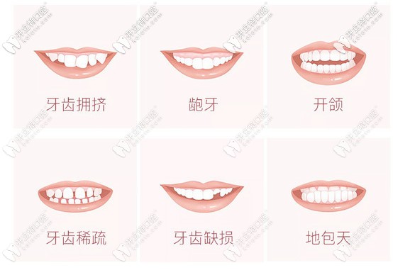 需要矫正牙齿的症状 需要矫正牙齿的症状