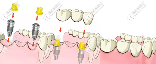 种植牙示意图