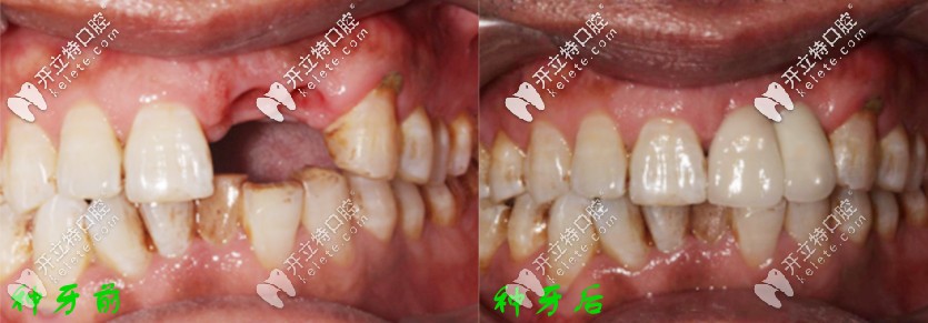 种牙前后对比 种牙前后对比