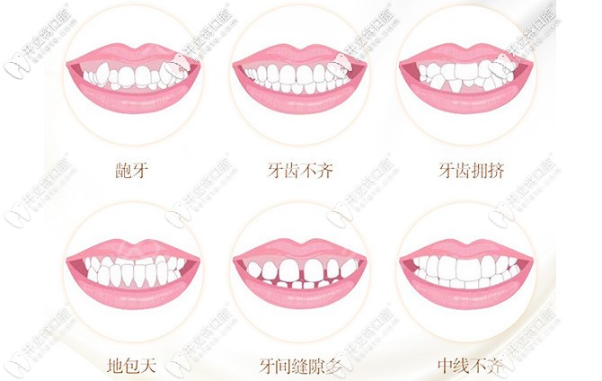 牙齿矫正的适应症状 牙齿矫正的适应症状