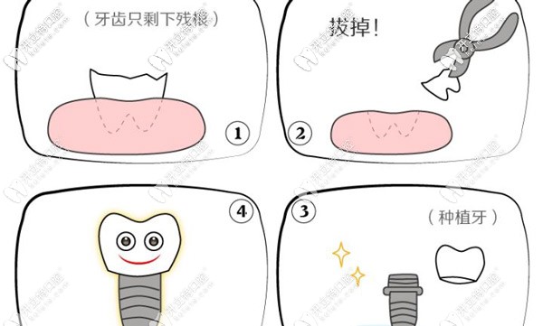 种植牙的流程图