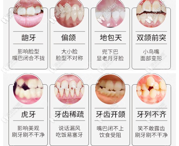 需要矫牙的几种症状